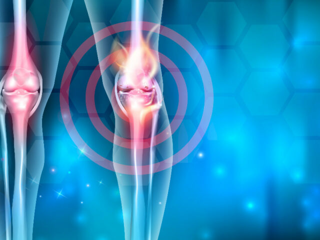 Protesi di ginocchio: tutto quello che devi sapere